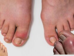 Cegah Asam Urat Tinggi Dengan Strategi Pintar Memilih Makanan Sehari-Hari