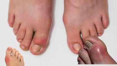 Cegah Asam Urat Tinggi Dengan Strategi Pintar Memilih Makanan Sehari-Hari